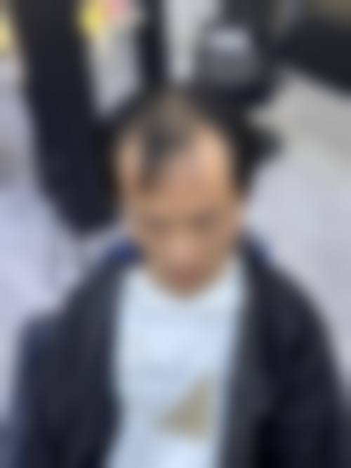四、重庆春草世纪植发医院实例