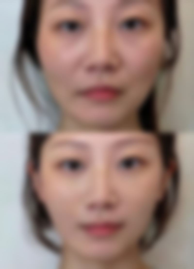 火龙果去眼袋是真的吗?食用火龙果对改善眼袋的作用