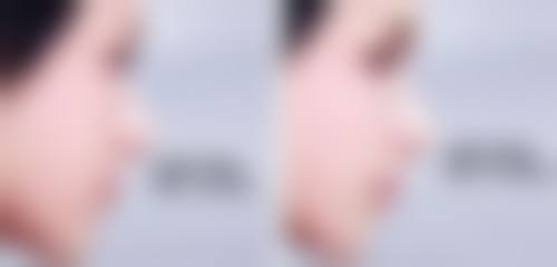 术后护理:确保割双眼皮后碰水洗脸安心的关键