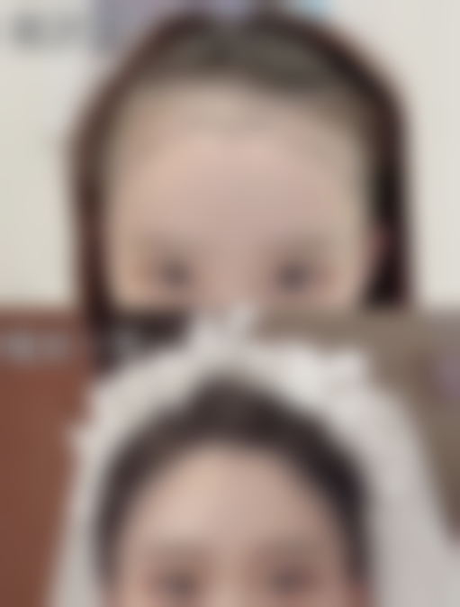 隆鼻的神奇骨粉究竟是什么？羟基磷灰石材料塑形鼻梁，效果可维持5 - 10年 