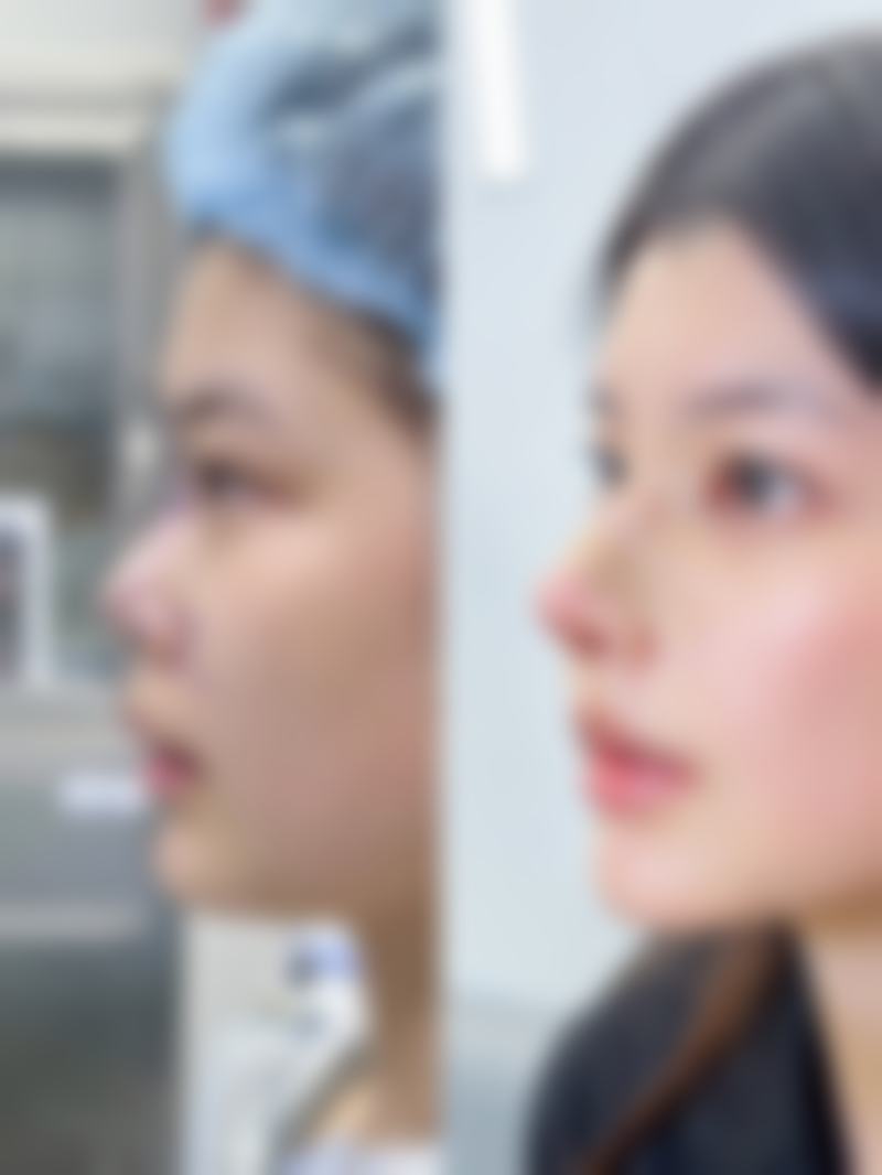 五、宁波鄞州蝶沙整形医院实例