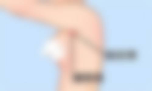 双眼皮术后何时涂祛疤膏更有效?不同手术方式的涂抹时机差异