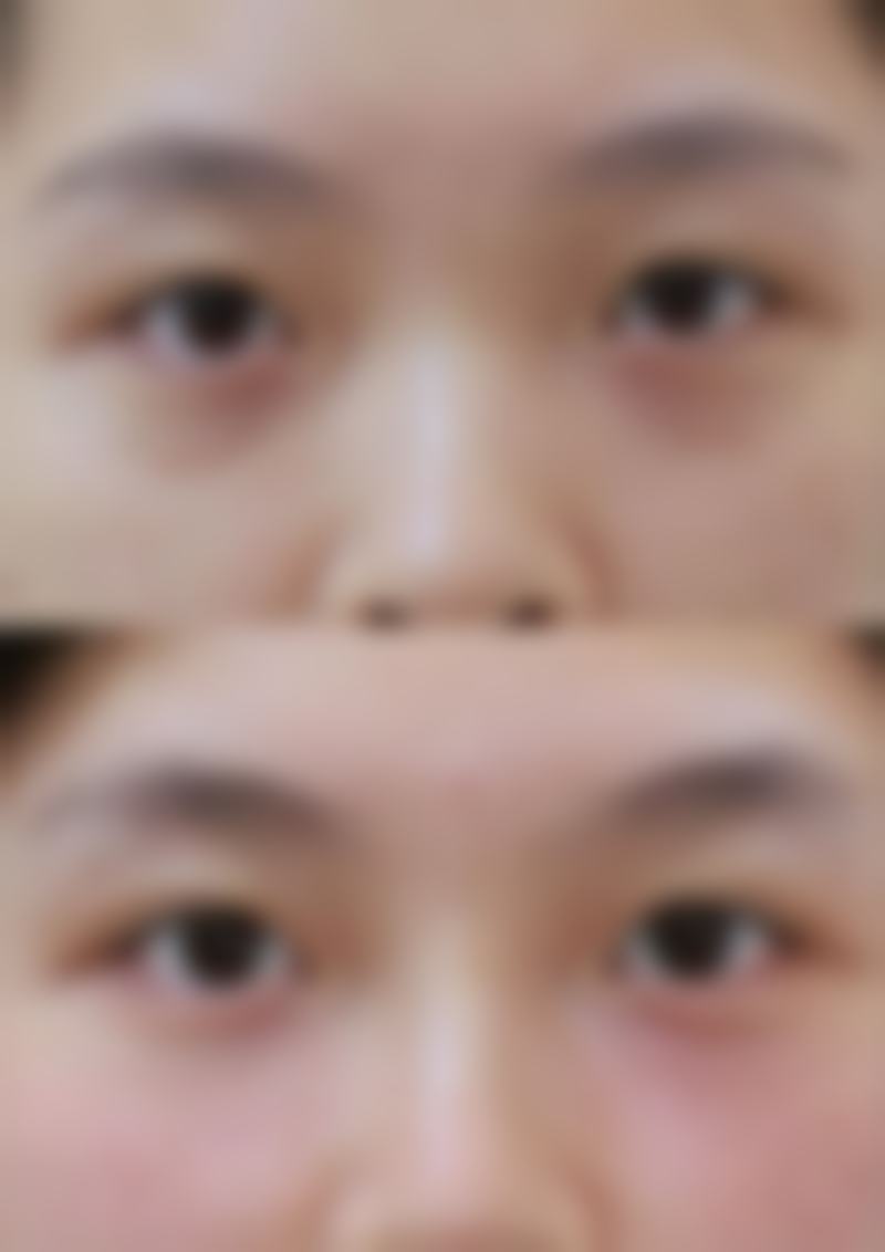 非手术改善方案:轻松解决鼻尖显形问题