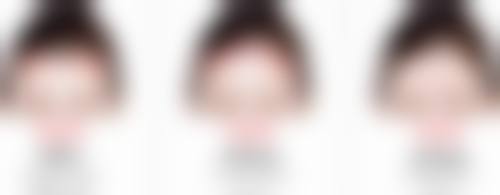 割双眼皮留下的痕迹能修复吗？不同阶段方案揭秘，助你淡化痕迹重获美眸 
