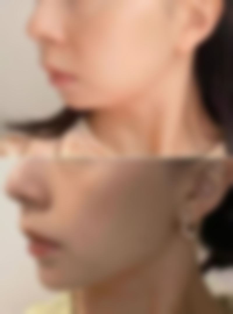 面部除皱选啥针？玻尿酸除皱针的填充魅力