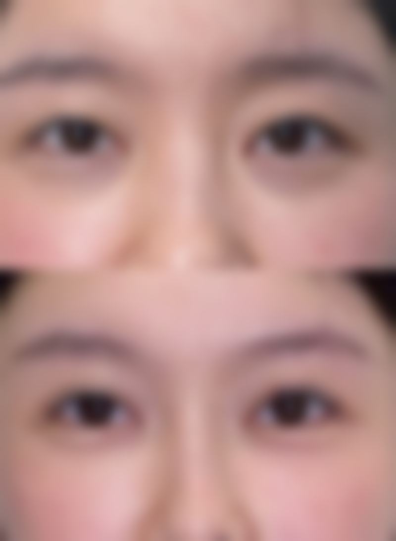 割双眼皮陈旧性疤痕修复方案