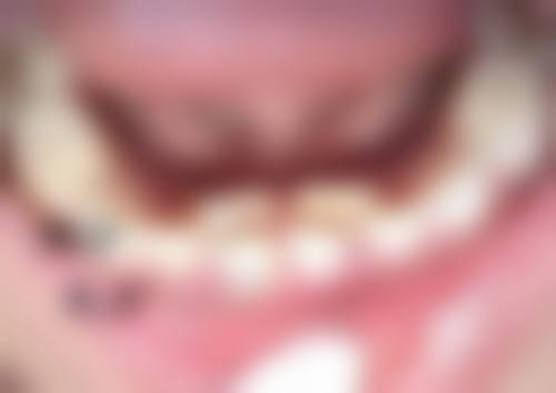 发际线种植效果究竟能维持多久？受个体与护理因素影响，或10 - 20年，或永久保持 