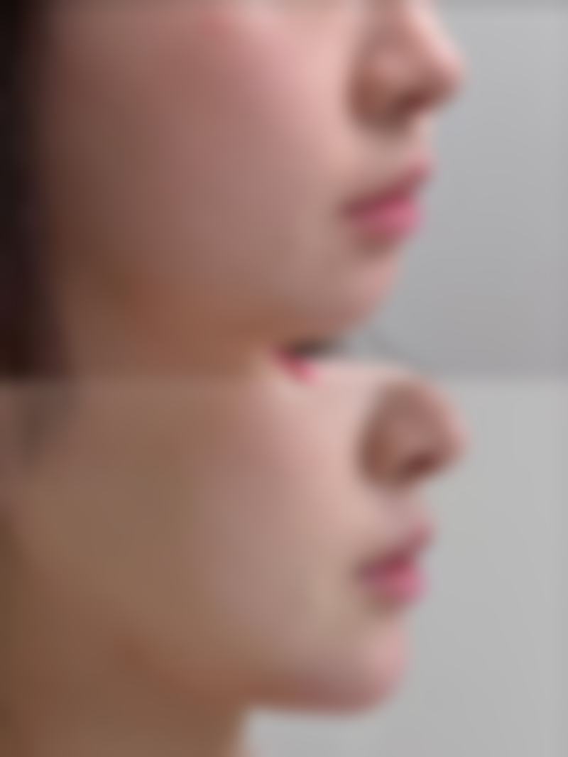 自体脂肪隆胸隐忧之修复时间长