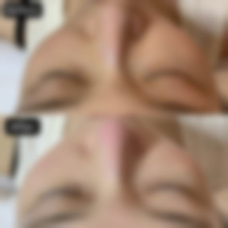 夏天割眼袋可行吗?防晒工作不能少