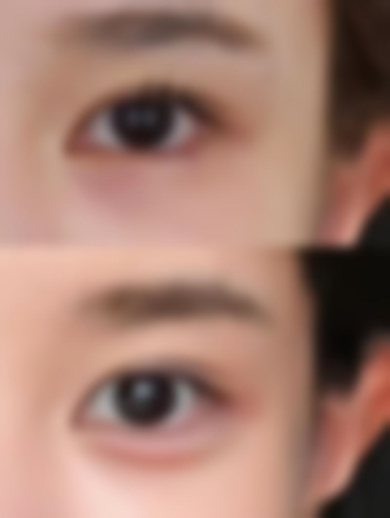 为何会出现一只双眼皮？后天影响别忽视