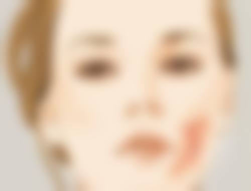 光子嫩肤后疤痕颜色反黑别慌！多维度处理方法助你快速改善反黑难题