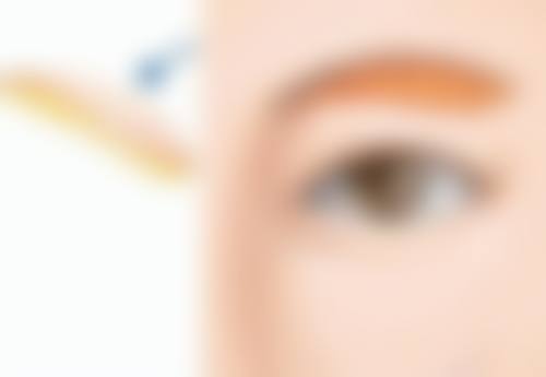 埋线双眼皮究竟能管多少年？多因素影响下，部分情况可达 10 年以上！ 