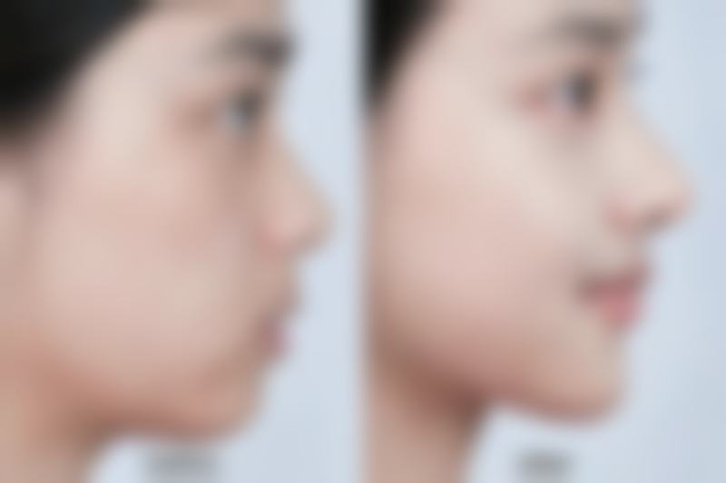 蛋白线隆鼻成效能持续多久?不同医生的观点
