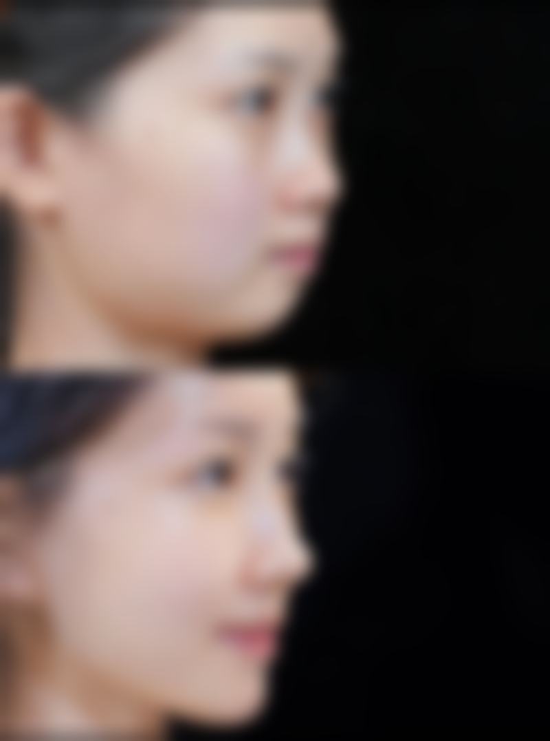 冰块敷眼去眼袋,该怎么操作?