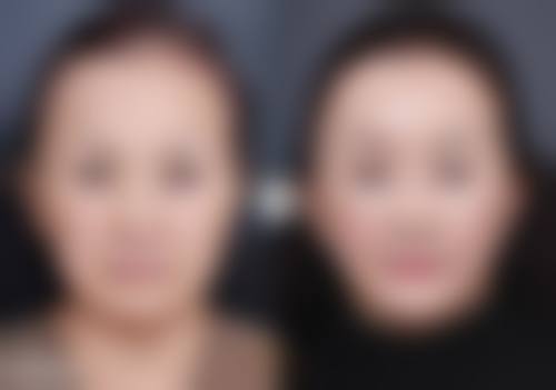 如何加速隆鼻后消肿?畅享快速修复自然美