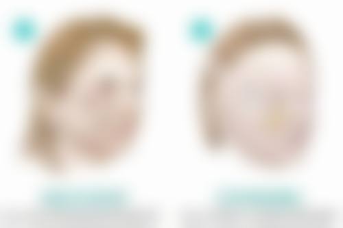 甘油真能去除眼袋吗?正规去眼袋方法大揭秘