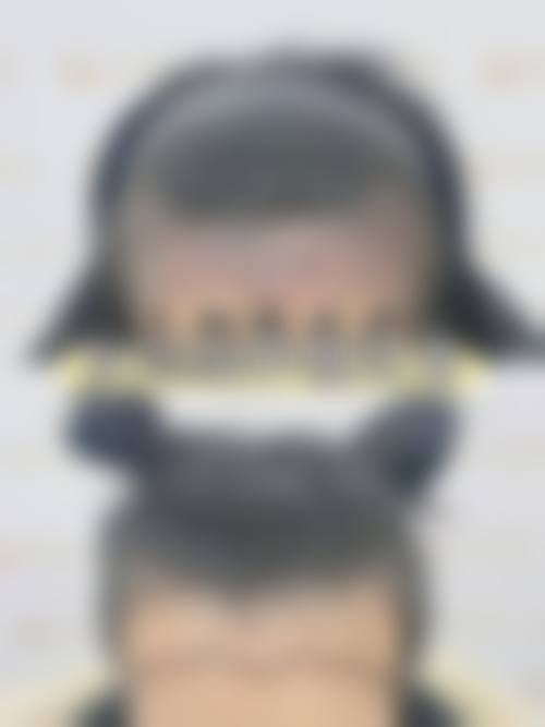 五、武汉雍禾美度植发医院实例