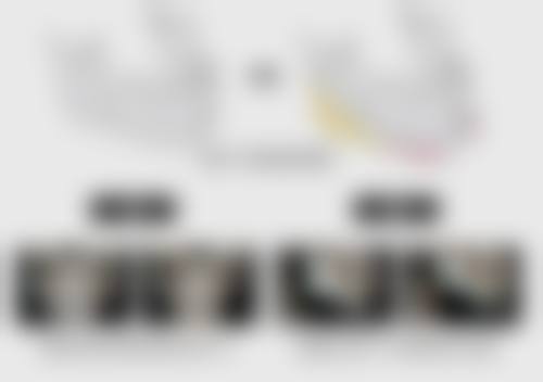 割双眼皮需注意啥?术后修复期间保持良好心态