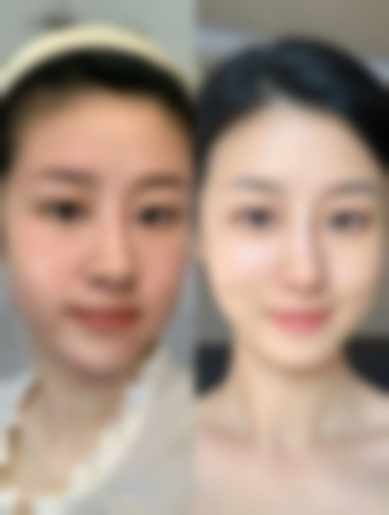 术后护理:助力双眼皮理想呈现