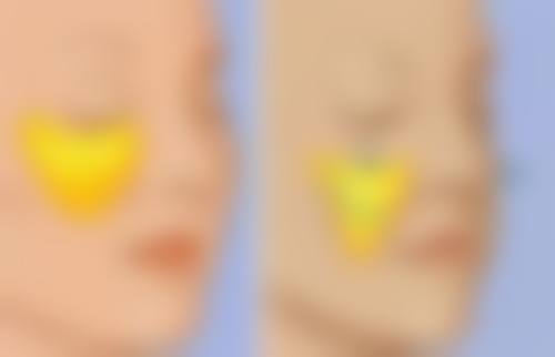 面部手术疤痕如何去除?多种疗法结合优势多