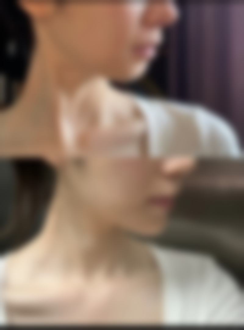 玻尿酸注射隆鼻能持续多久？注射材料是关键