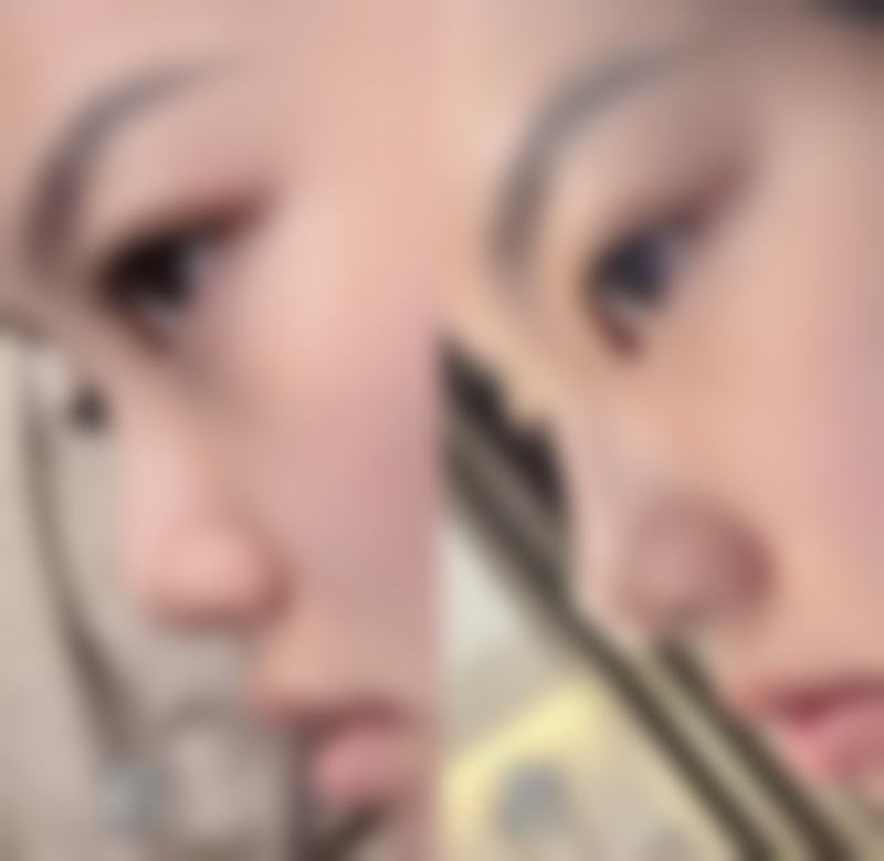 如何轻松清除眼袋?通用注意事项要牢记