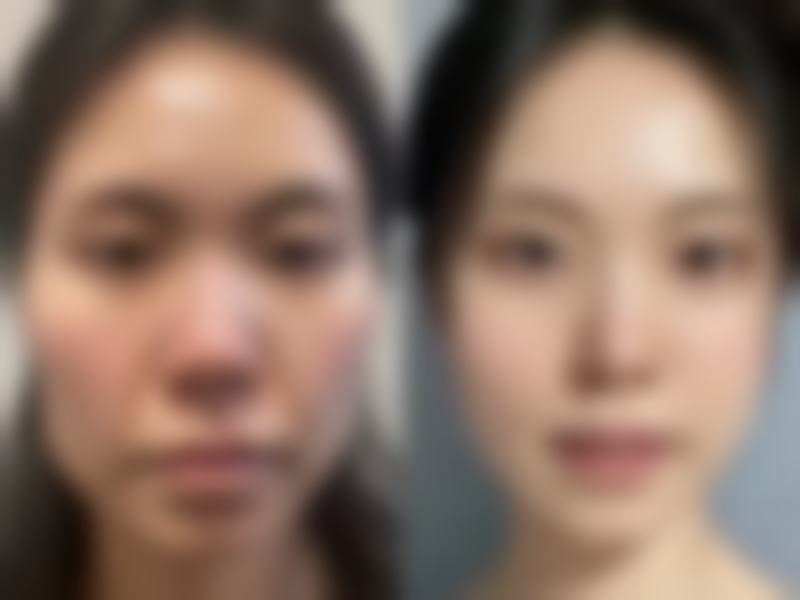有眼袋又有泪沟咋办?药物治疗辅助改善