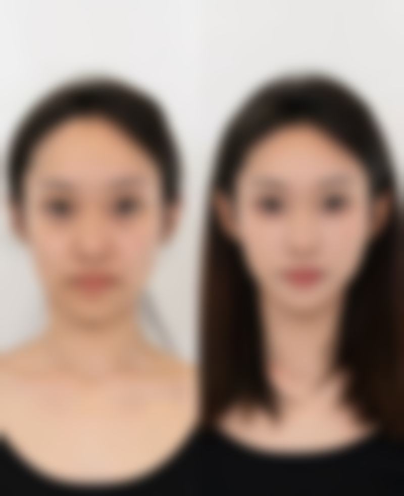 种植毛发用别人毛囊未来有希望不?