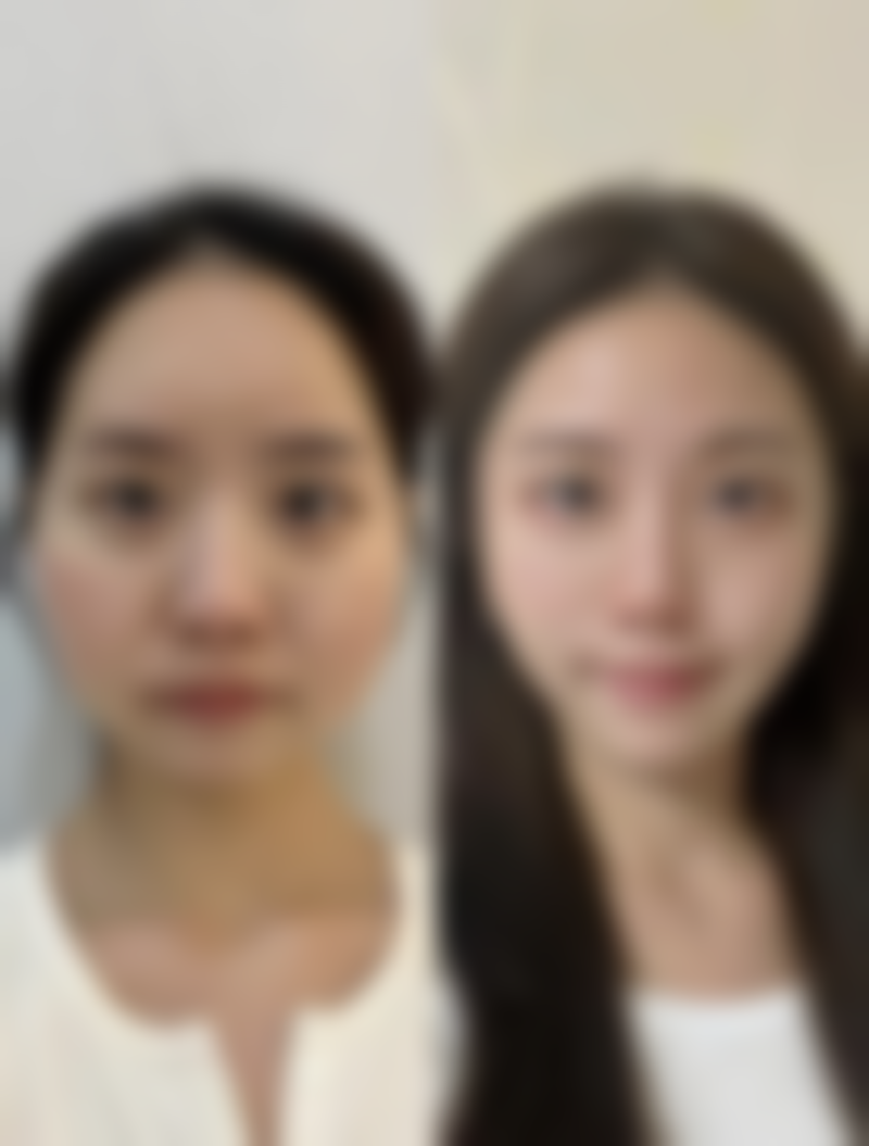 想消除眼袋?非手术物理/医美治疗来帮忙