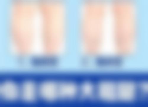 大腿吸脂后多久能同房？时间差异与抽脂范围、体质及护理相关，了解这些少走弯路 