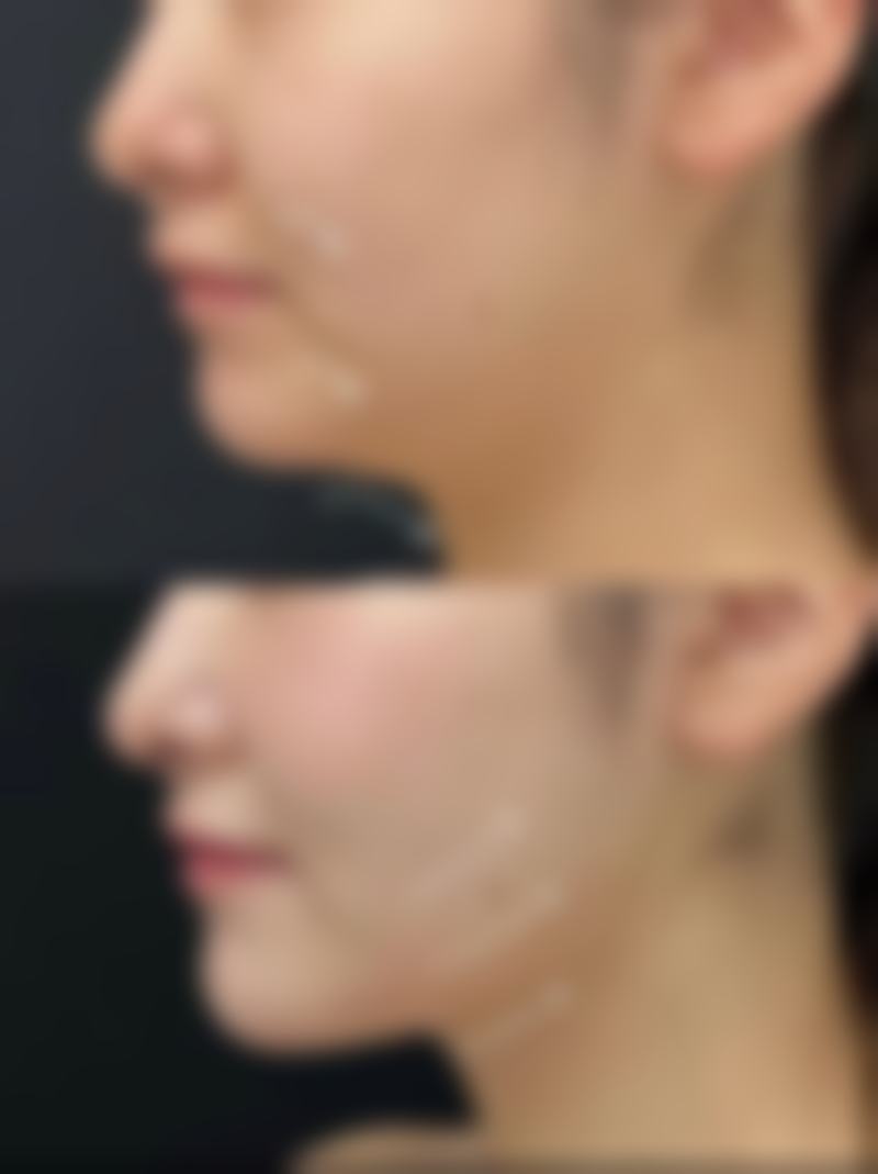 辅助加速修复的护理要点,保护面部吸脂成效