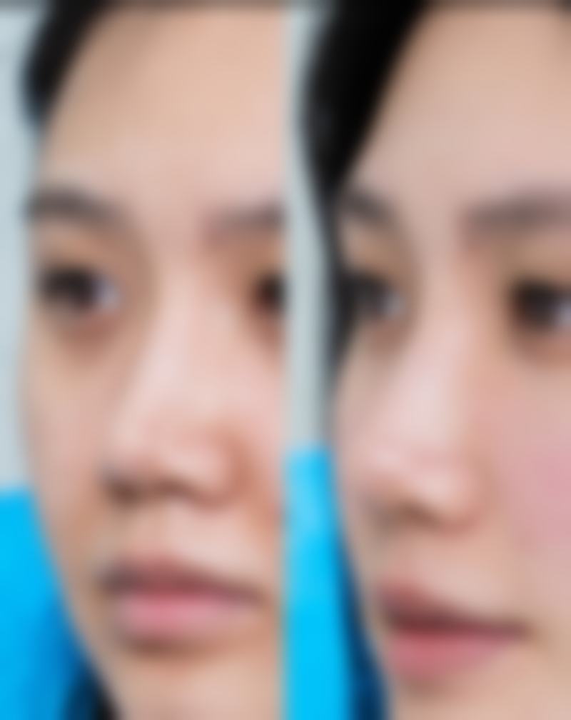 面部吸脂多久见成效？多数1 - 3个月显效果，护理得当还能加速恢复！ 