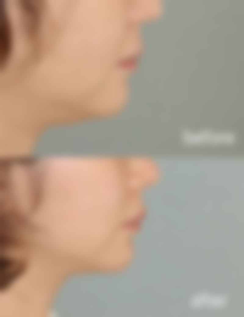如何有效改善疤痕增生?治疗价格心中有数