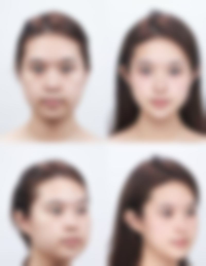五、石家庄润美整形医院实例