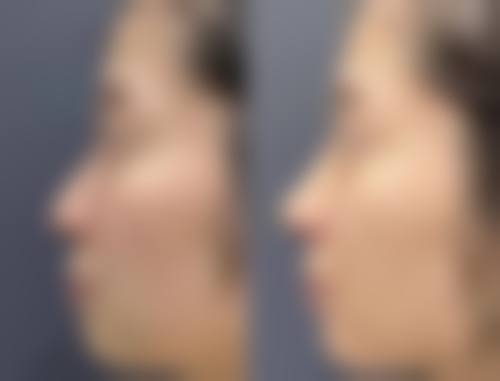 点阵激光:治疗次数看疤痕大小