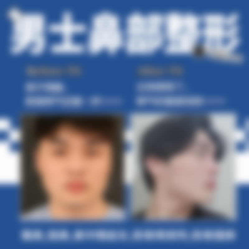 韩国TS整形医院深层提拉复位3万焕回紧致年轻轮廓求美者真实分享