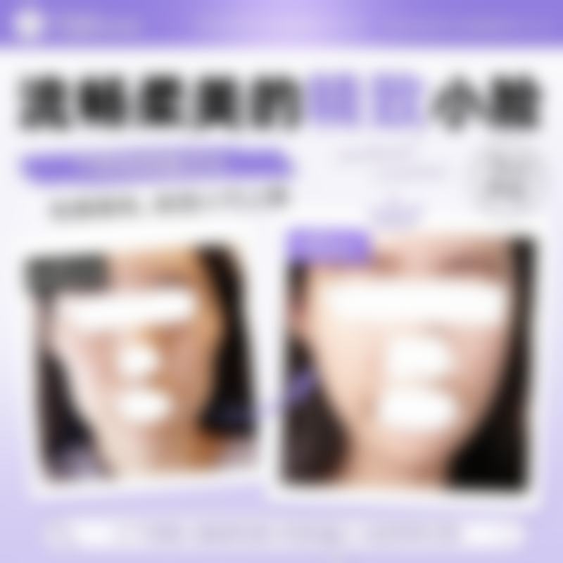 韩国TS整形医院李相均做双重固定颧骨缩小术约3万的求美者真实分享