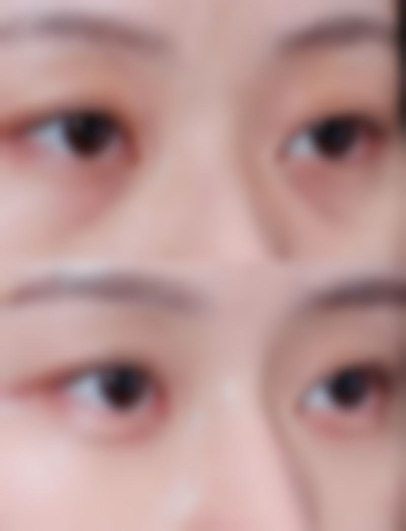 点痣留疤莫担忧!激光治疗显身手